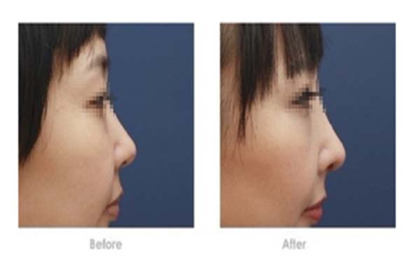 硅膠<a href=http://m.f3bb6.cn/listinfo-737-0.html target=_blank class=infotextkey>隆鼻</a>多久可以恢復