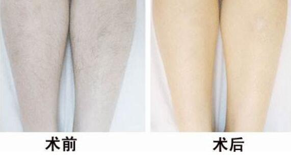 冰點<a href=http://m.f3bb6.cn/listinfo-670-0.html target=_blank class=infotextkey>脫毛</a>后的注意事項