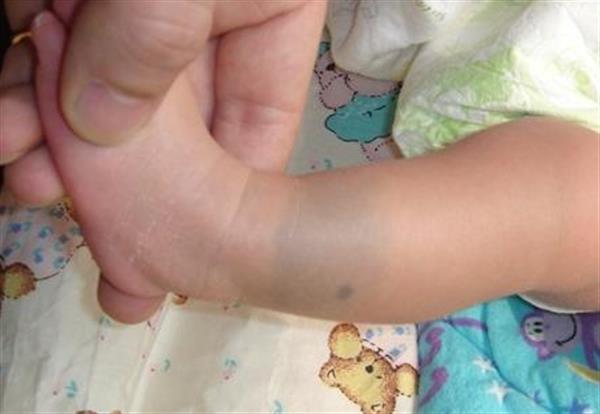 胎記是怎么形成的