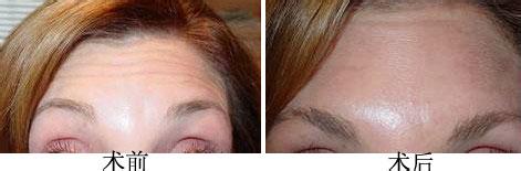 光子<a href=http://m.f3bb6.cn/listinfo-770-0.html target=_blank class=infotextkey>嫩膚</a>可以去掉抬頭紋嗎