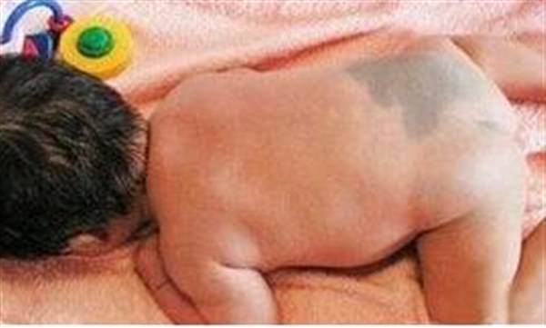 激光<a href=http://m.f3bb6.cn/listinfo-773-0.html target=_blank class=infotextkey>去胎記</a>后多久恢復