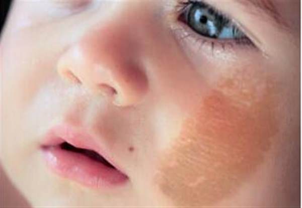 胎記能徹底清除嗎