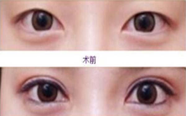 埋線<a href=http://m.f3bb6.cn/listinfo-724-0.html target=_blank class=infotextkey>雙眼皮</a>拆線多少錢