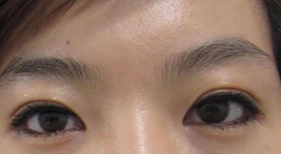 埋線<a href=http://m.f3bb6.cn/listinfo-724-0.html target=_blank class=infotextkey>雙眼皮</a>寬能改窄嗎