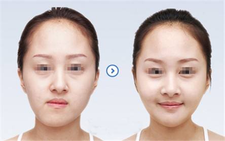  做<a href=http://m.f3bb6.cn/listinfo-632-0.html target=_blank class=infotextkey>正頜</a>手術(shù)多少錢