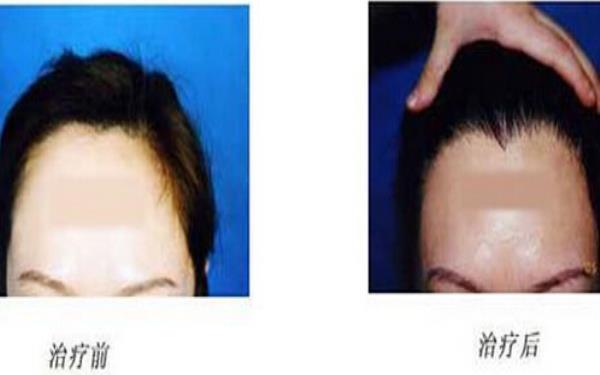 <a href=http://m.f3bb6.cn/listinfo-669-0.html target=_blank class=infotextkey>美人尖種植</a>的過程及護理方式