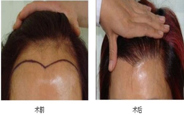 <a href=http://m.f3bb6.cn/listinfo-669-0.html target=_blank class=infotextkey>美人尖種植</a>的方式及手術的安全性