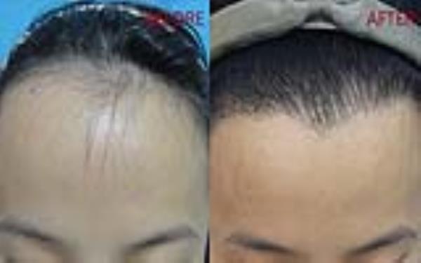 <a href=http://m.f3bb6.cn/listinfo-669-0.html target=_blank class=infotextkey>美人尖種植</a>的安全性及術(shù)后護(hù)理方式