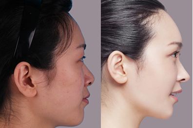 韓式生科<a href=http://m.f3bb6.cn/listinfo-737-0.html target=_blank class=infotextkey>隆鼻</a>能終身嗎