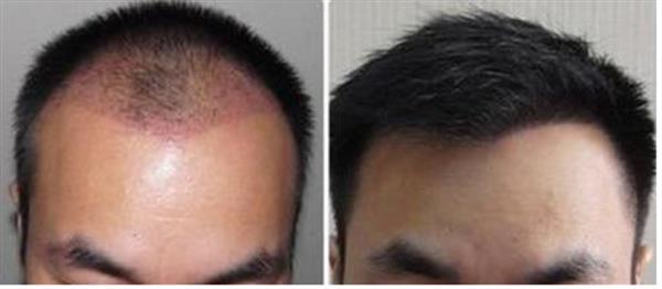 重慶頭發種植的價格