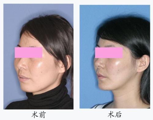 <a href=http://m.f3bb6.cn/listinfo-632-0.html target=_blank class=infotextkey>正頜</a>手術后臉型改變大嗎