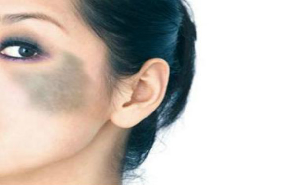 黑色胎記要不要去除