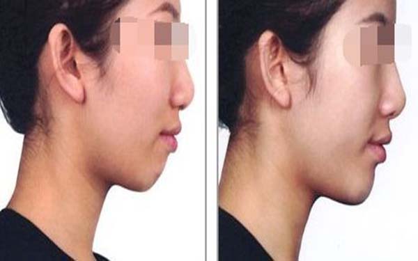 臉左右不對稱怎么辦