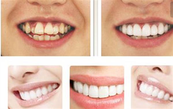 種植牙要具備哪些條件