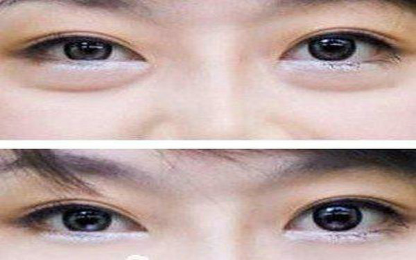 內路祛眼袋危害