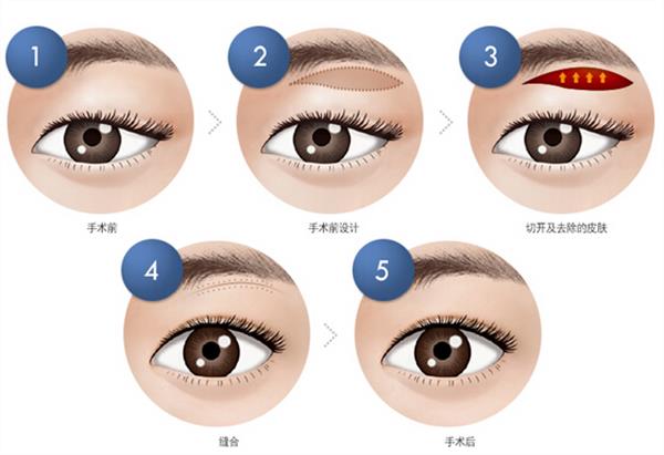 做<a href=http://m.f3bb6.cn/listinfo-655-0.html target=_blank class=infotextkey>切眉</a>手術有什么壞處