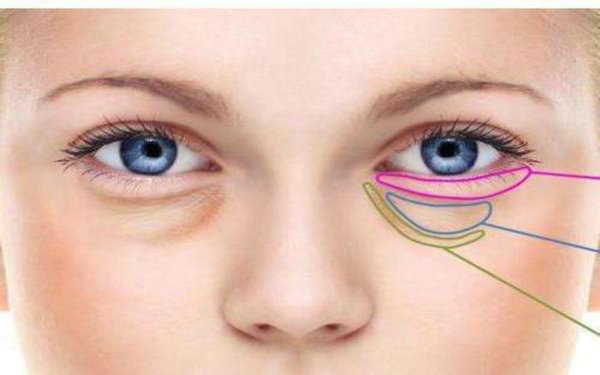 內路祛眼袋有后遺癥嗎?