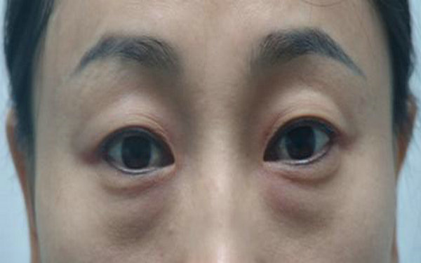 內切<a href=http://m.f3bb6.cn/listinfo-708-0.html target=_blank class=infotextkey>去眼袋</a>費用