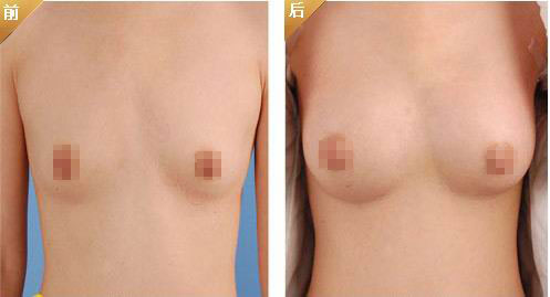 豐胸多久能同房