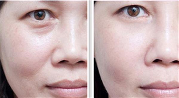 抽脂法<a href=http://m.f3bb6.cn/listinfo-708-0.html target=_blank class=infotextkey>去眼袋</a>能維持多久