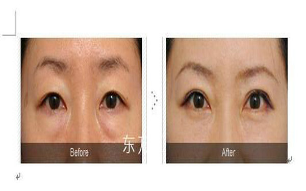 內切做眼袋多久能恢復?