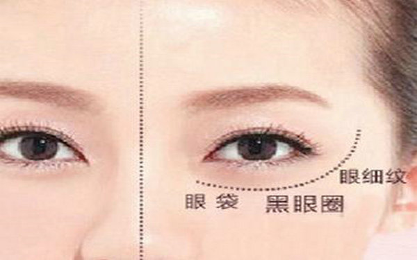 內吸祛眼袋多久能上班?