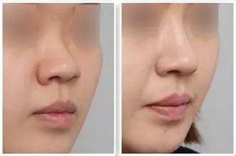 注射式<a href=http://m.f3bb6.cn/listinfo-737-0.html target=_blank class=infotextkey>隆鼻</a>安全嗎