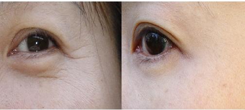 什么是<a href=http://m.f3bb6.cn/listinfo-614-0.html target=_blank class=infotextkey>除皺</a>抗衰