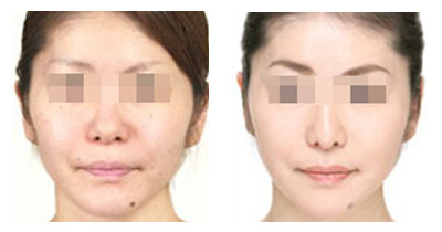 臉部激光后注意事項