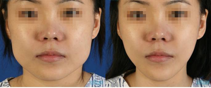 <a href=http://m.f3bb6.cn/listinfo-629-0.html target=_blank class=infotextkey>下頜角</a>截骨后的注意事項