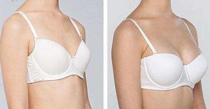 豐胸法比較好的有哪些