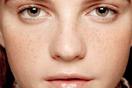 黃褐斑能去掉嗎