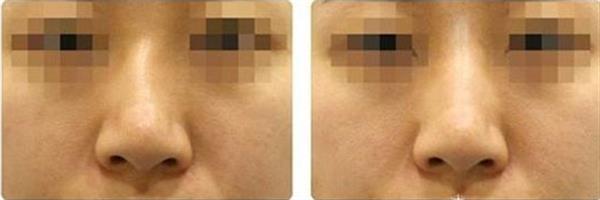 <a href=http://m.f3bb6.cn/listinfo-751-0.html target=_blank class=infotextkey>歪鼻矯正</a>手術的費用大概多少