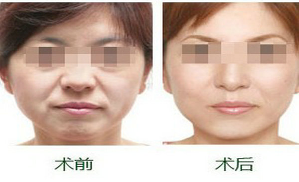 提眉術(shù)可有效改善哪些癥狀？