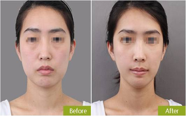 botox<a href=http://m.f3bb6.cn/listinfo-614-0.html target=_blank class=infotextkey>除皺</a>瘦型素<a href=http://m.f3bb6.cn/listinfo-614-0.html target=_blank class=infotextkey>除皺</a>瘦型素<a href=http://m.f3bb6.cn/listinfo-631-0.html target=_blank class=infotextkey>瘦臉</a><a href=http://m.f3bb6.cn/listinfo-614-0.html target=_blank class=infotextkey>除皺</a>一般價格