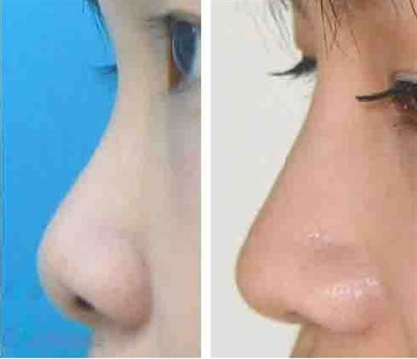 肋軟骨<a href=http://m.f3bb6.cn/listinfo-737-0.html target=_blank class=infotextkey>隆鼻</a>效果好嗎