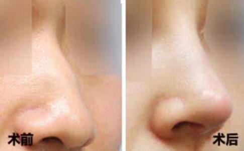 肋軟骨綜合<a href=http://m.f3bb6.cn/listinfo-737-0.html target=_blank class=infotextkey>隆鼻</a>價位