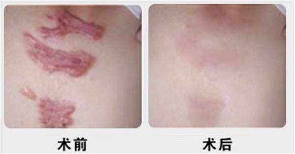 去除手術(shù)疤痕的方法
