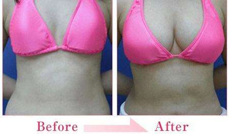 自體脂肪豐胸安全嗎