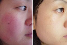 光子<a href=http://m.f3bb6.cn/listinfo-770-0.html target=_blank class=infotextkey>嫩膚</a>返黑了怎么辦