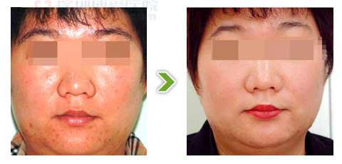 光子<a href=http://m.f3bb6.cn/listinfo-770-0.html target=_blank class=infotextkey>嫩膚</a>和彩光的區(qū)別