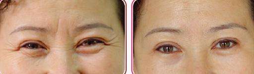 光子<a href=http://m.f3bb6.cn/listinfo-770-0.html target=_blank class=infotextkey>嫩膚</a>多久一次