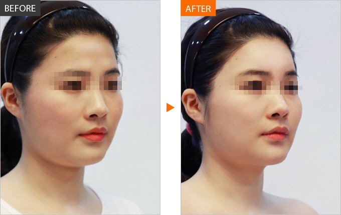 膠原蛋白針劑<a href=http://m.f3bb6.cn/listinfo-643-0.html target=_blank class=infotextkey>豐額頭</a>效果好不好