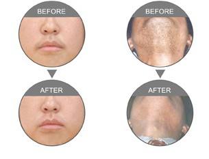 光子<a href=http://m.f3bb6.cn/listinfo-663-0.html target=_blank class=infotextkey>面部<a href=http://m.f3bb6.cn/listinfo-670-0.html target=_blank class=infotextkey>脫毛</a></a>多少錢