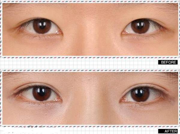 做<a href=http://m.f3bb6.cn/listinfo-724-0.html target=_blank class=infotextkey>雙眼皮</a>什么季節好得快