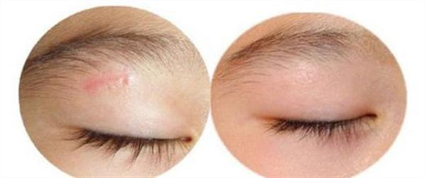 額頭有凹陷疤痕怎么修復