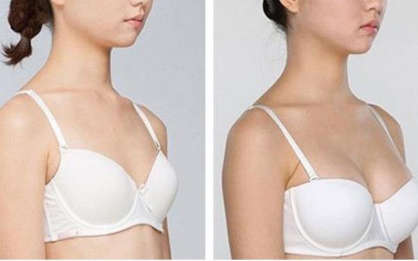 自體脂肪<a href=http://m.f3bb6.cn/listinfo-618-0.html target=_blank class=infotextkey>隆胸</a>整形費用