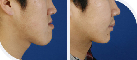 骨性地包天手術多少錢