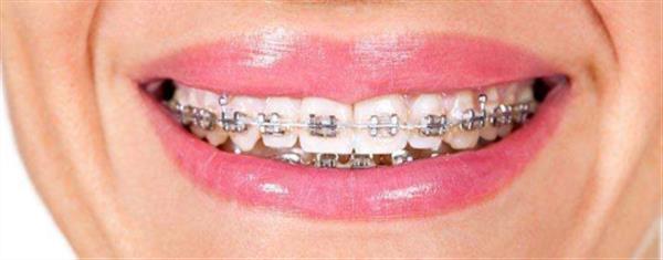 做<a href=http://m.f3bb6.cn/listinfo-824-0.html target=_blank class=infotextkey>牙齒矯正</a>擁擠注意事項都有什么