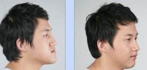 骨性<a href=http://m.f3bb6.cn/listinfo-641-0.html target=_blank class=infotextkey>地包天矯正</a>費(fèi)用